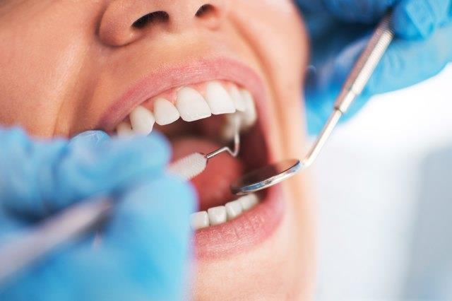 Apa yang menyebabkan deposit kalsium pada gigi dan bagaimana mencegahnya