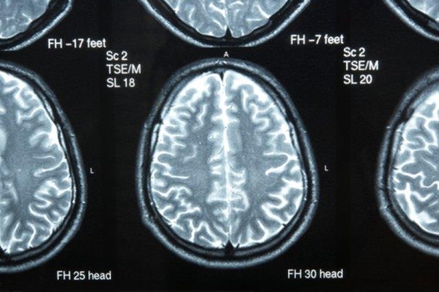 Gehirnübungen für Broca Aphasie Gehirnübungen für Broca Aphasie