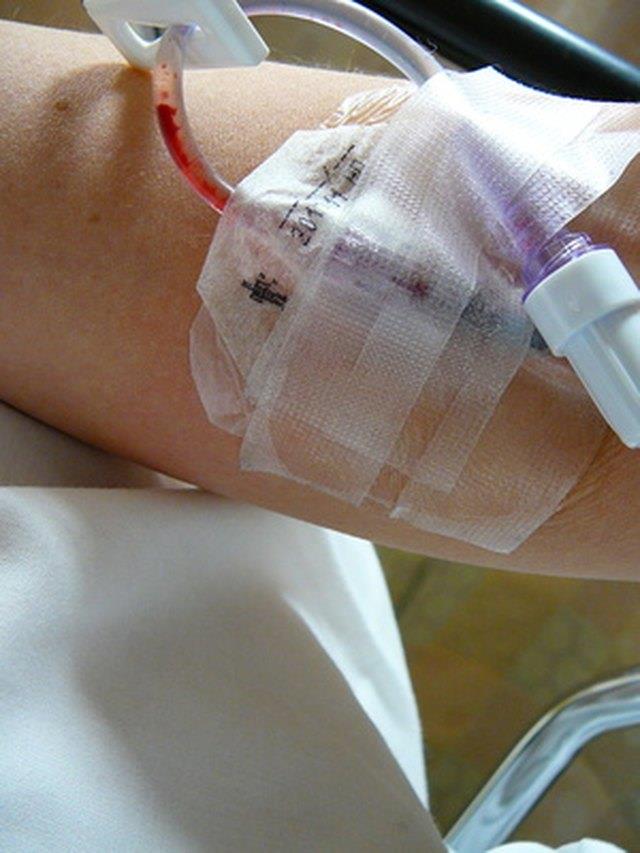 Infiltrierte IV Komplikationen bei Nervenschäden und Cellulitis Infiltrierte IV Komplikationen bei Nervenschäden und Cellulitis