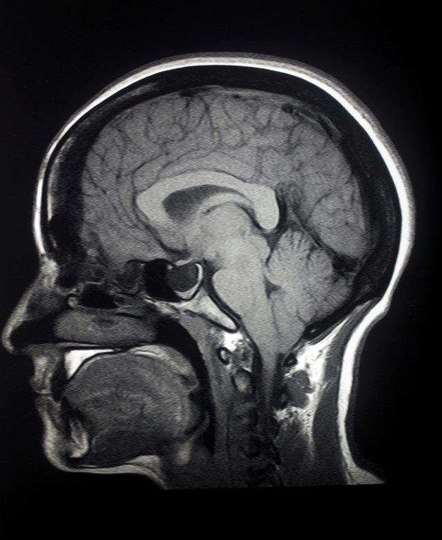 Was sind die Ursachen für Myelin-Nervenschäden? Was sind die Ursachen für Myelin-Nervenschäden?
