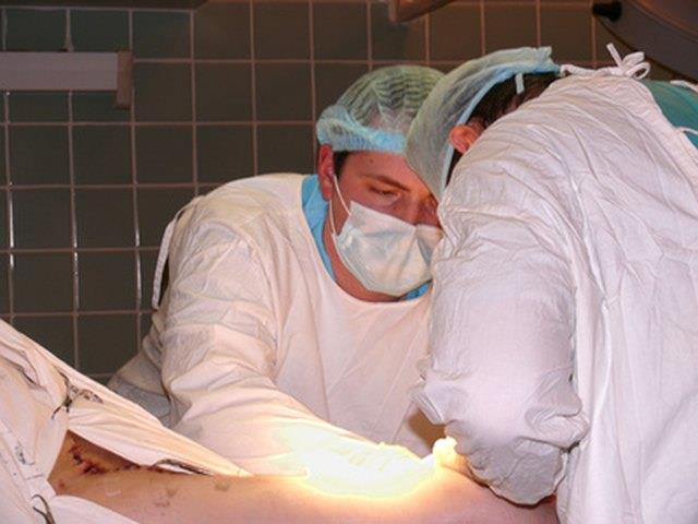 Was sind die Nebenwirkungen einer Kolostomieumkehr? Was sind die Nebenwirkungen einer Kolostomieumkehr?
