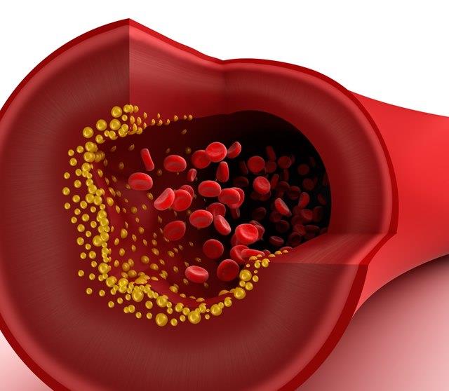 Können Sie Arterien mit niedrigem Cholesterinspiegel blockiert haben? Können Sie Arterien mit niedrigem Cholesterinspiegel blockiert haben?