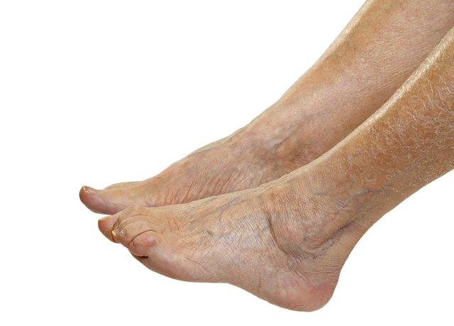 Rote Fahne Anzeichen für Herzinsuffizienz Rote Fahne Anzeichen für Herzinsuffizienz