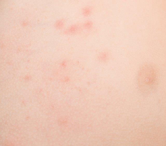 Haupthilfsmittel für Kontakt-Dermatitis Haupthilfsmittel für Kontakt-Dermatitis